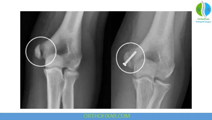 Medial Epicondyle Fracture fixation