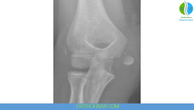 Medial Epicondyle Fracture