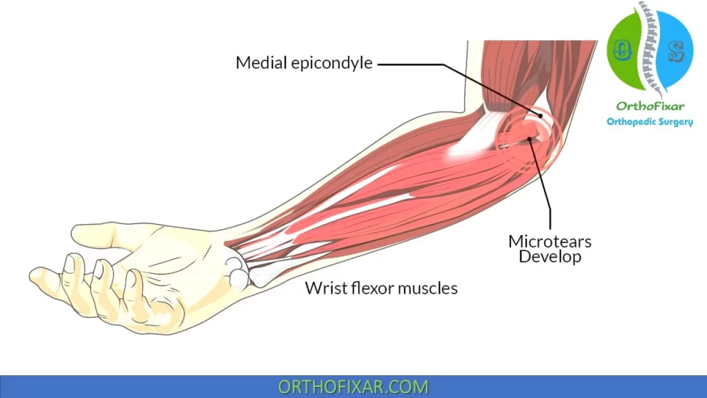 Medial Epicondylitis • Easy Explained - OrthoFixar 2022