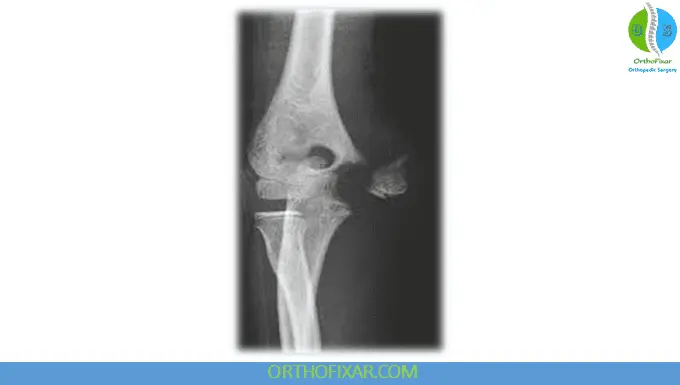 Pediatric Medial Humeral Condyle Fractures 5 Medial Humeral Condyle Fractures xray