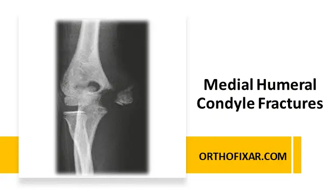 Medial Humeral Condyle Fractures