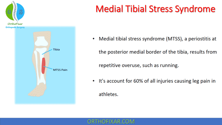 Medial Tibial Stress Syndrome