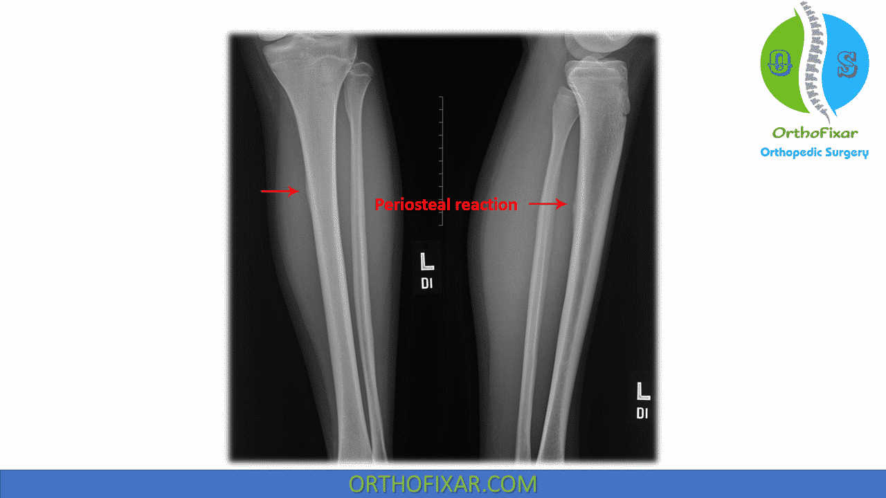 muscles medial tibial stress syndrome