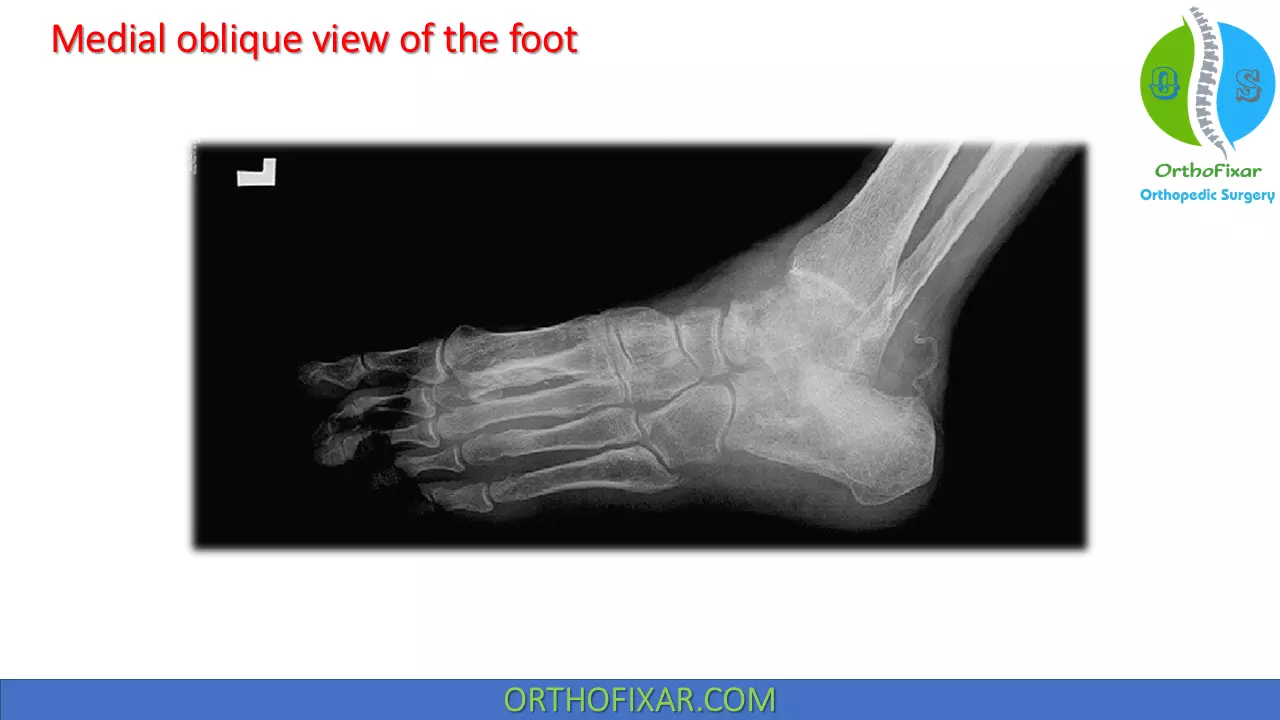 Medial oblique view of the foot