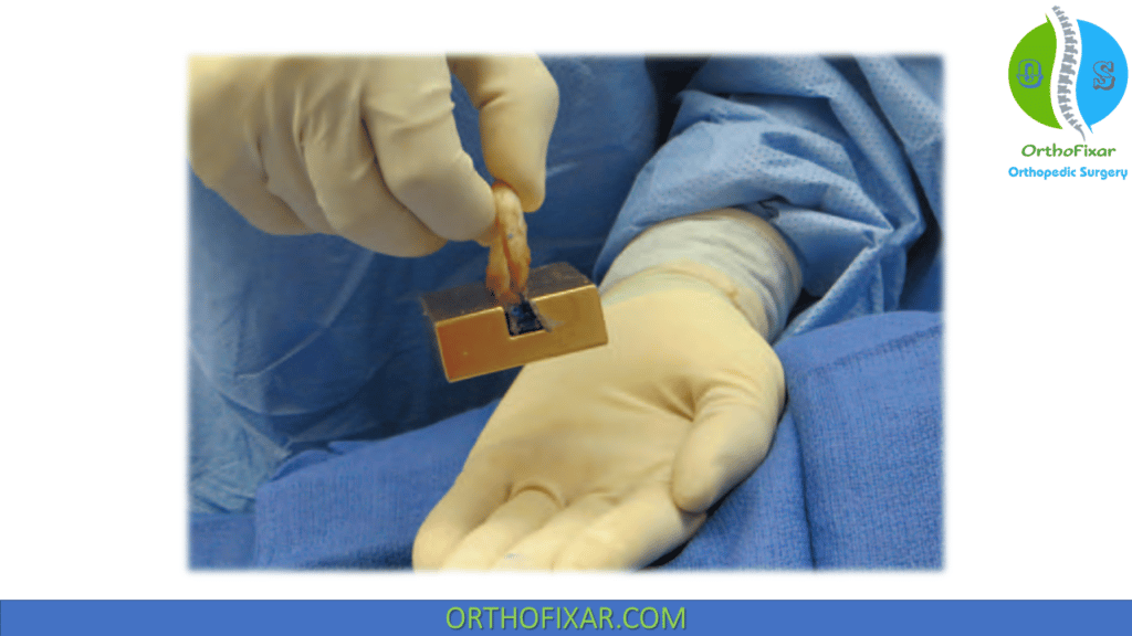 Meniscal Allograft Transplantation (2)