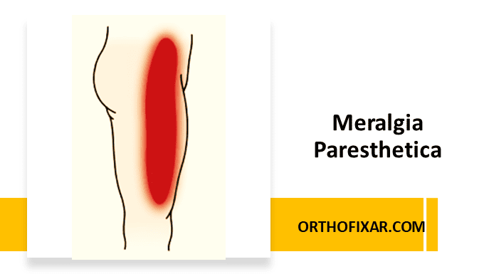 Meralgia Paresthetica