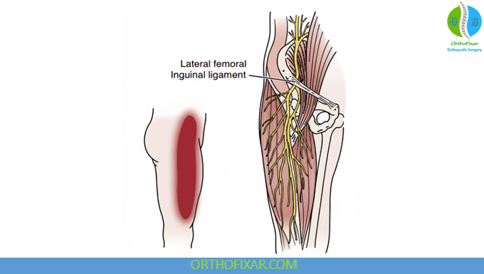 Meralgia Paresthetica Overview 1 Meralgia Paresthetica - Lateral Femoral Cutaneous Nerve
