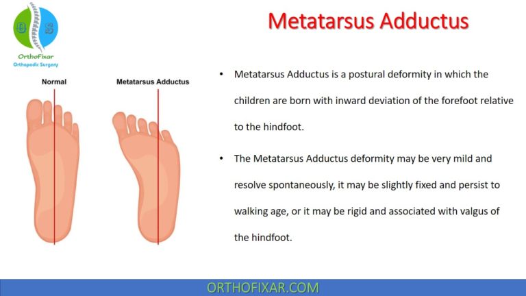 Metatarsus Adductus