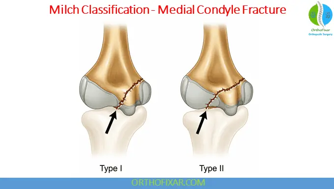 Pediatric Medial Humeral Condyle Fractures 6 Milch Classification Medial Humeral Condyle Fractures