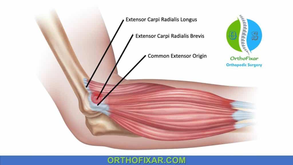 Mill's Test | Lateral Epicondylitis Assessment | OrthoFixar 2024