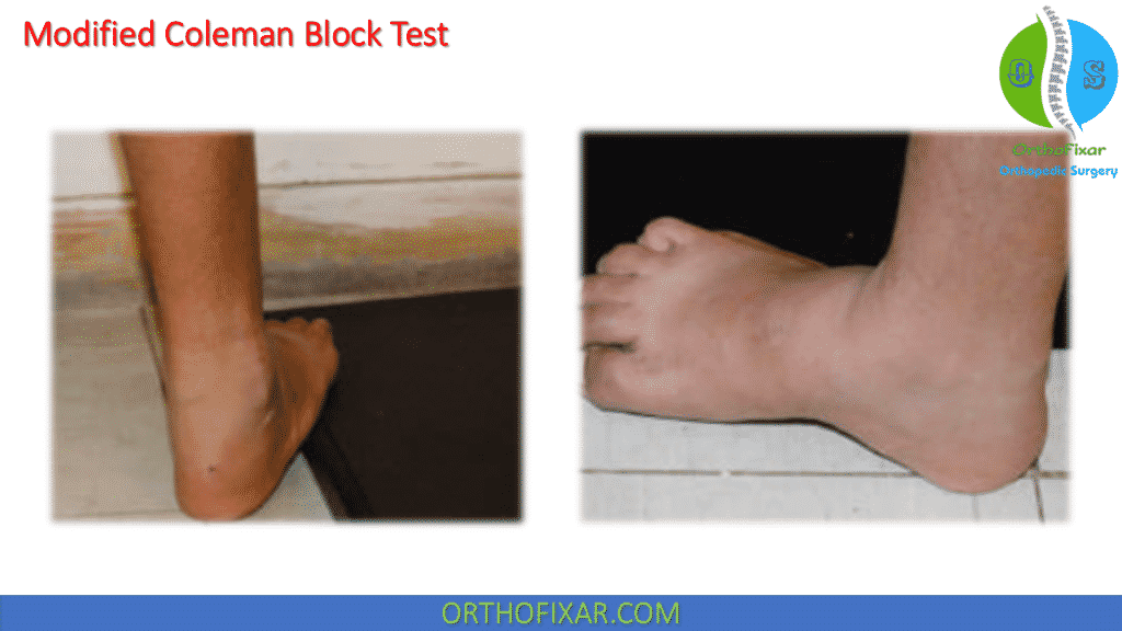 Modified Coleman Block Test
