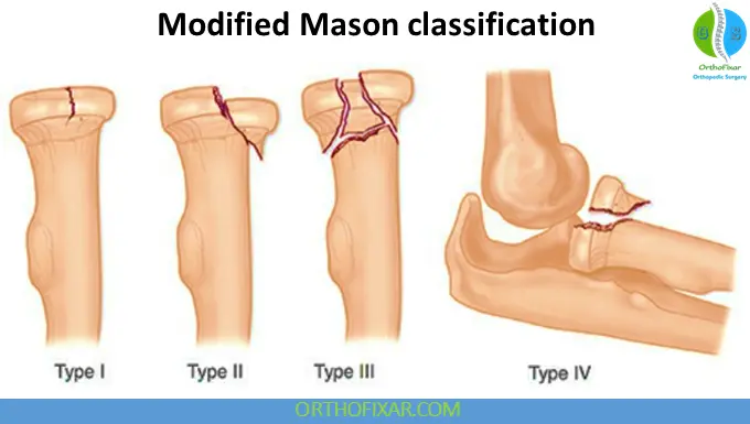 Modified Mason Classification for Radial Head Fractures
