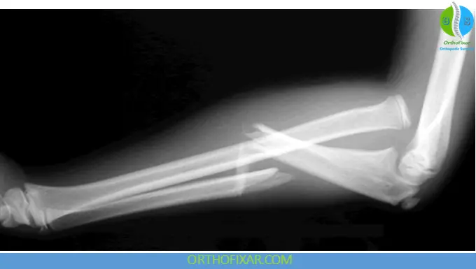 Monteggia Fracture xray