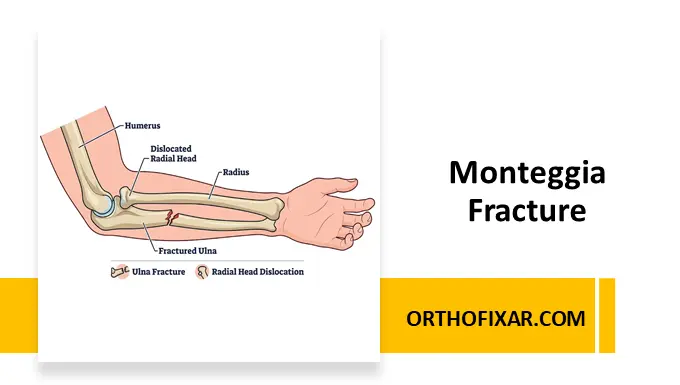 Monteggia Fracture