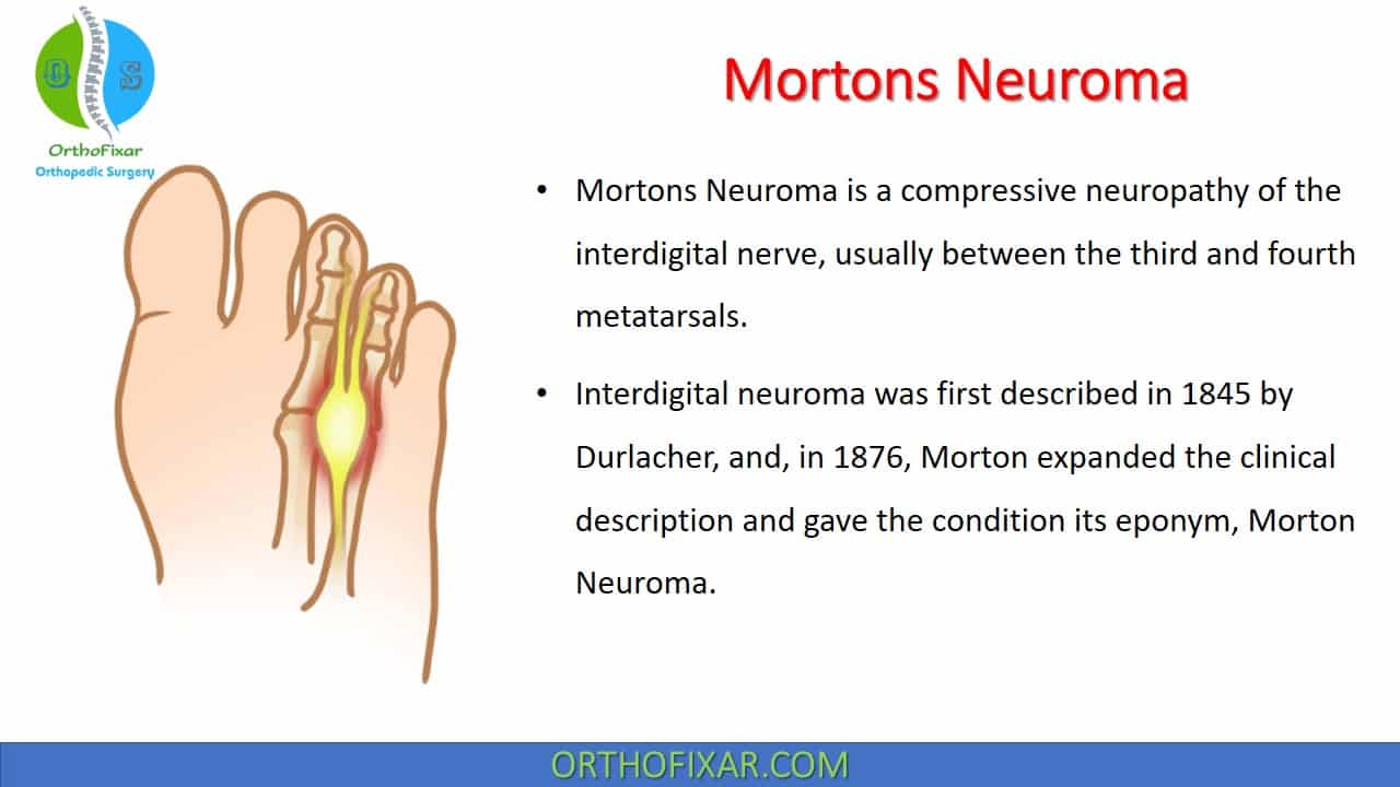 Mortons Neuroma • Easy Explained Orthofixar 2023