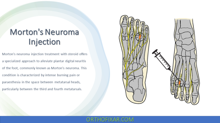 Morton's Neuroma Injection