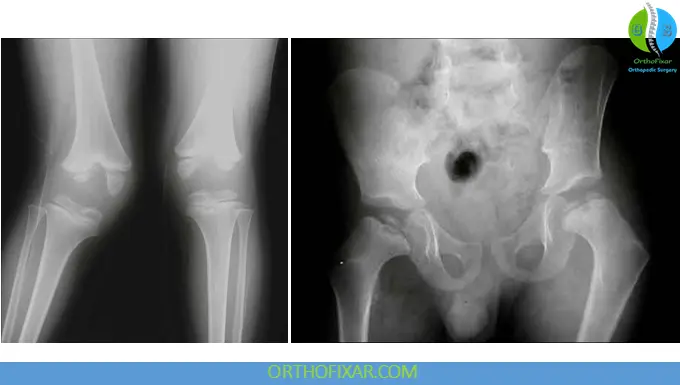 Multiple Epiphyseal Dysplasia hip and knee xray