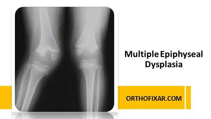 Multiple Epiphyseal Dysplasia