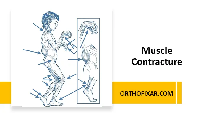 Muscle Contracture