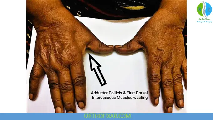 Muscle Wasting: Causes, Symptoms & Treatment 5 Muscle Wasting of the hand
