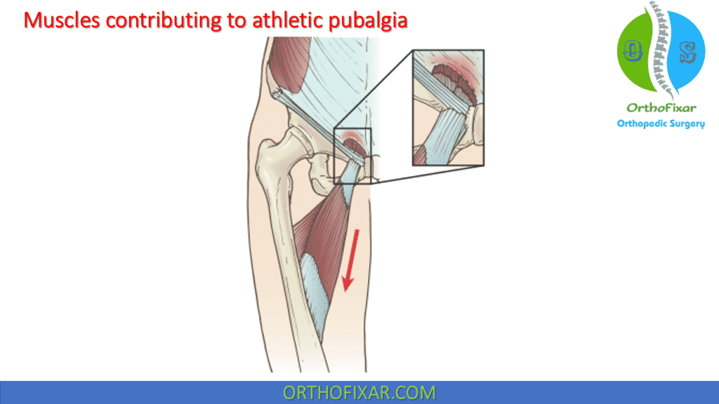 Muscles contributing to athletic pubalgia