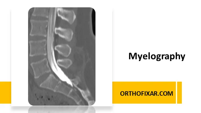 Myelography Indications, Procedure, Interpretation, and Complications
