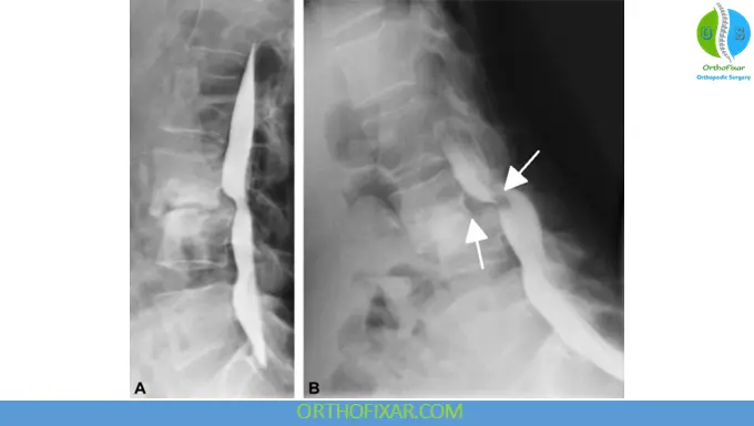 Myelography: Indications, Procedure, Interpretation & Complications 4 Myelography