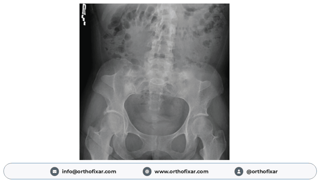Nail–Patella Syndrome Iliac Horns