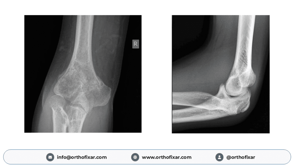 Nail–Patella Syndrome elbow
