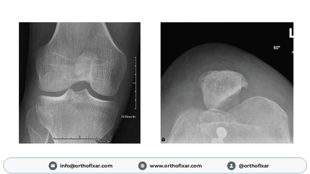 Nail–Patella Syndrome knee
