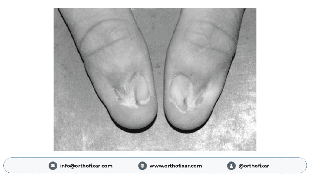 Nail-Patella Syndrome - nail