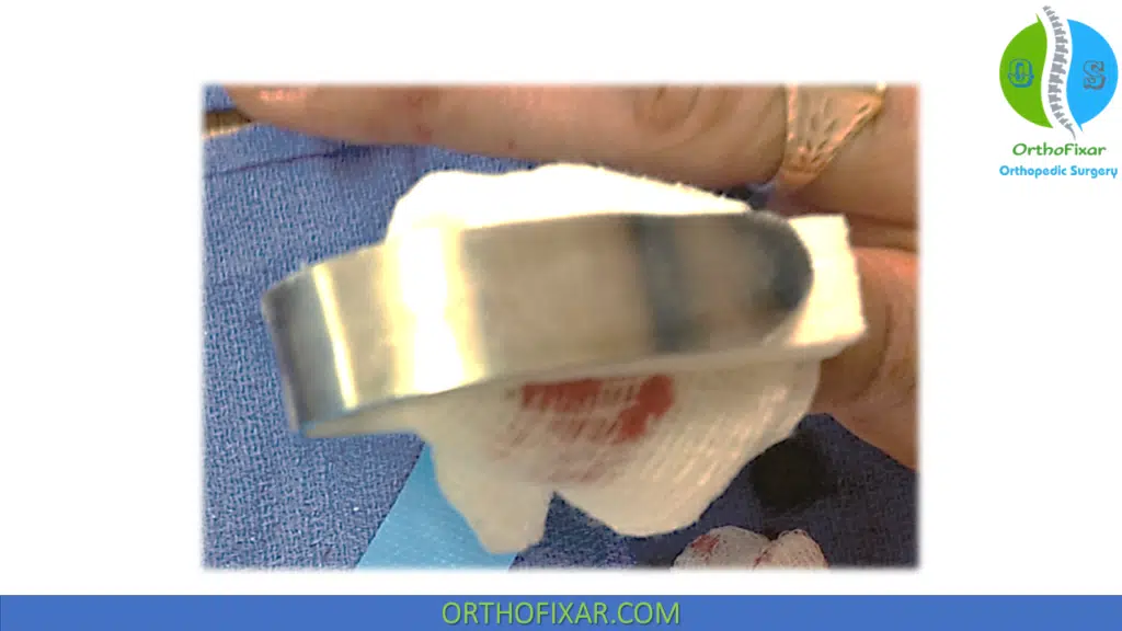 Nail Bed injury dressing