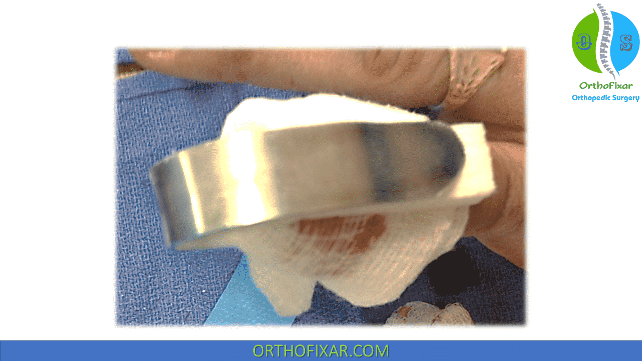 Nail Bed Repair OrthoFixar 2024