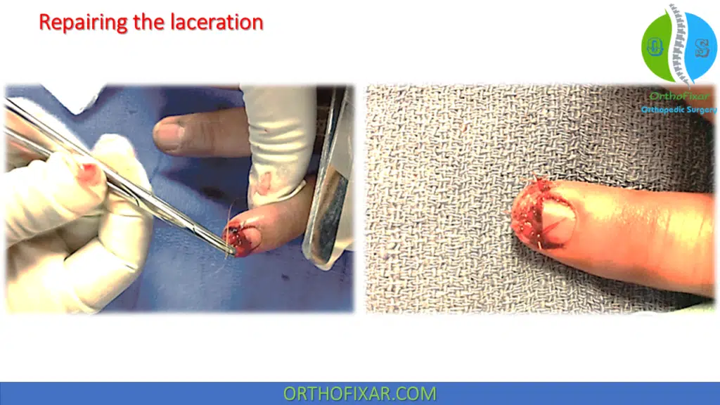 Nail Bed injury repair