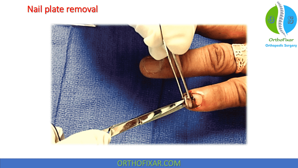 Nail Plate Removal