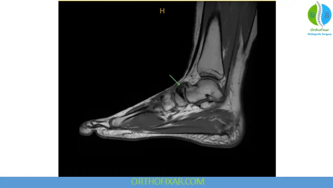 Navicular Stress Fracture mri