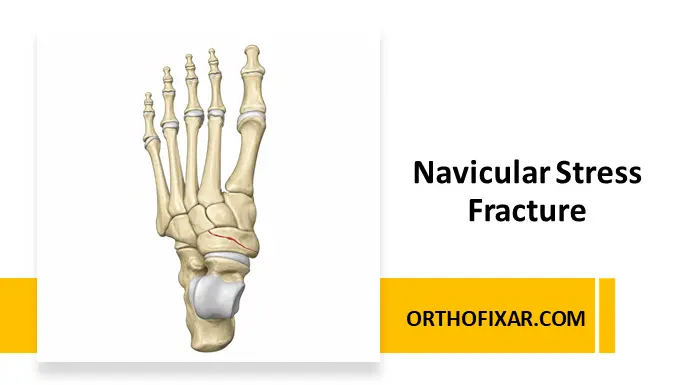 Navicular Stress Fracture