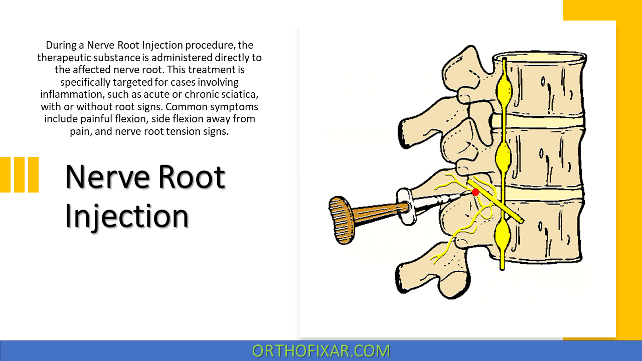  Nerve Root Injection 