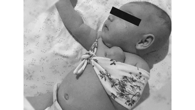 Newborn Clavicle Fracture treatment