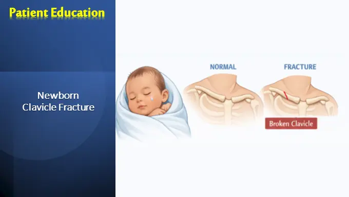 Newborn Clavicle Fracture
