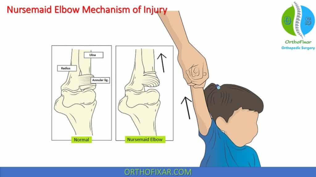 Nursemaid Elbow mechanism of injury