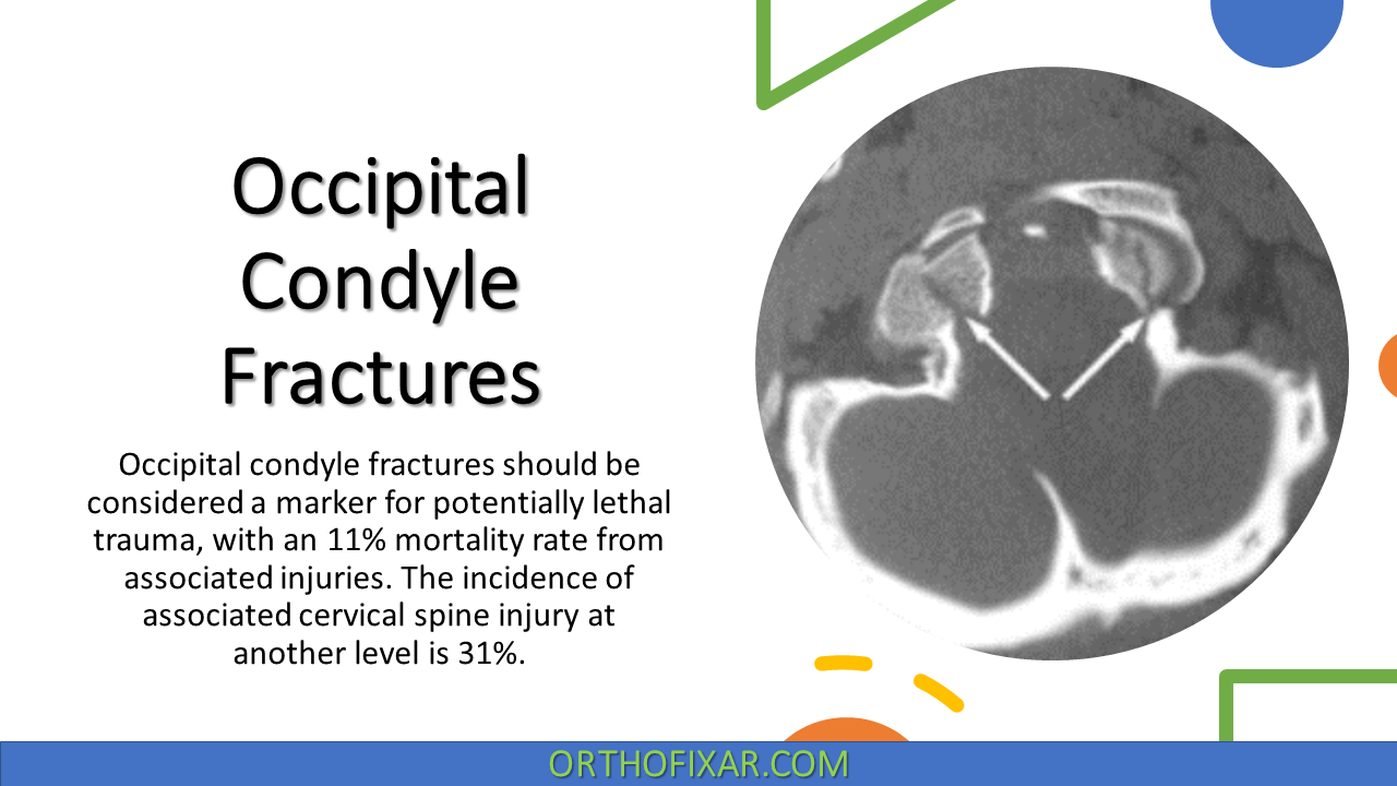  Occipital Condyle Fractures 