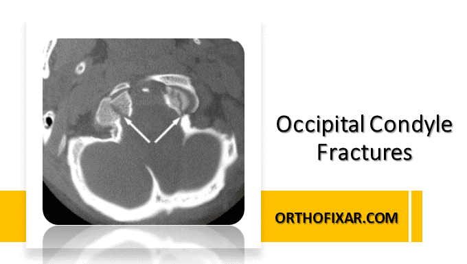  Occipital Condyle Fractures 