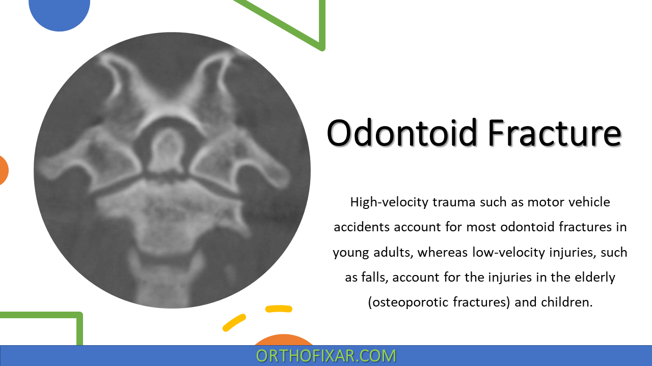  Odontoid Fracture 