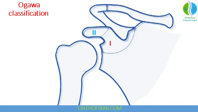 Ogawa classification for Coracoid Fracture