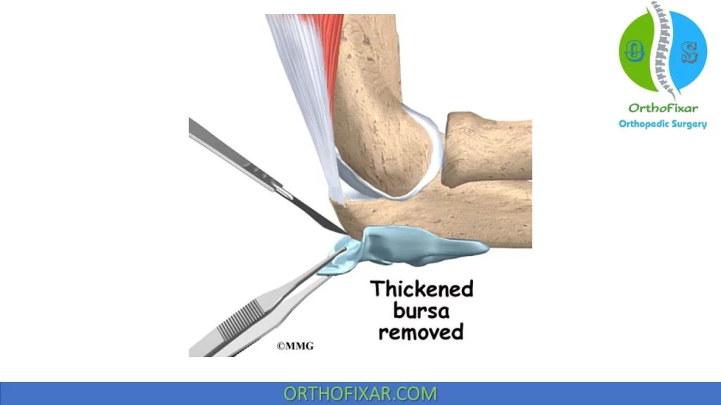 Olecranon Bursitis | Symptoms & Treatment | OrthoFixar 2024