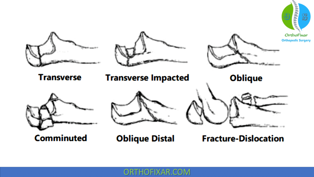 Olecranon Fracture Schatzker Classification