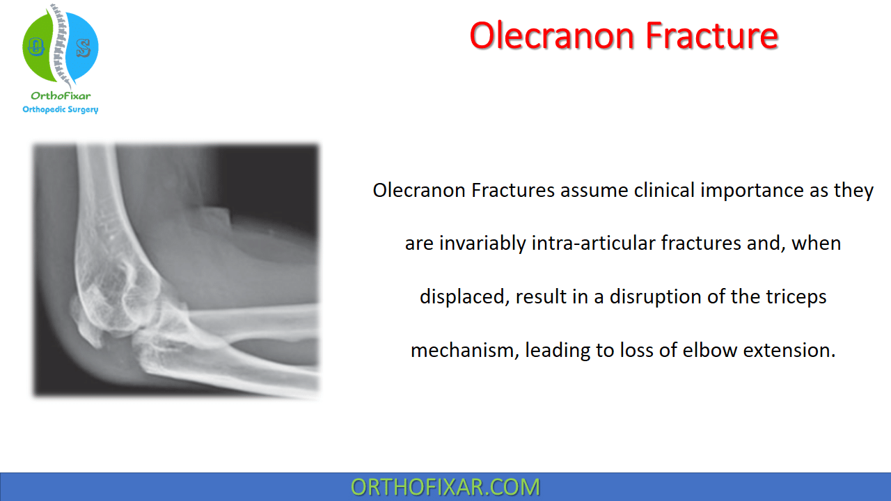 olecranon avulsion fracture