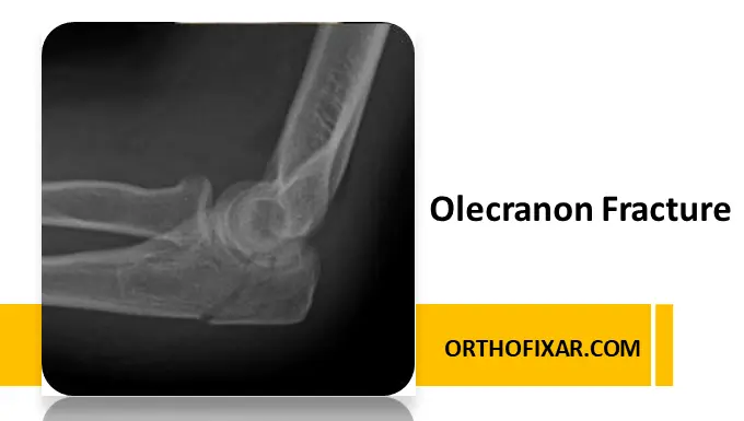 Olecranon Fracture