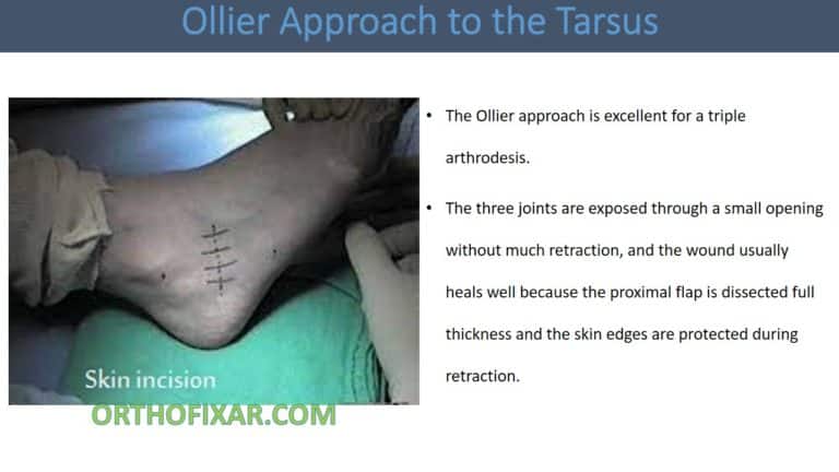 Ollier Approach to the Tarsus